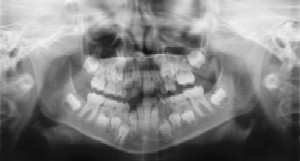 Lantzy Children's Dentistry - Dental Radiographs (X-Rays)
